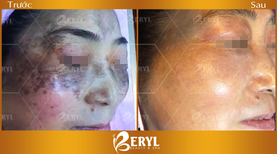 Hình ảnh trước sau điều trị nám CN Alphatech tại Beryl Beauty & Spa Hình ảnh trước sau điều trị nám CN Alphatech tại Beryl Beauty & Spa