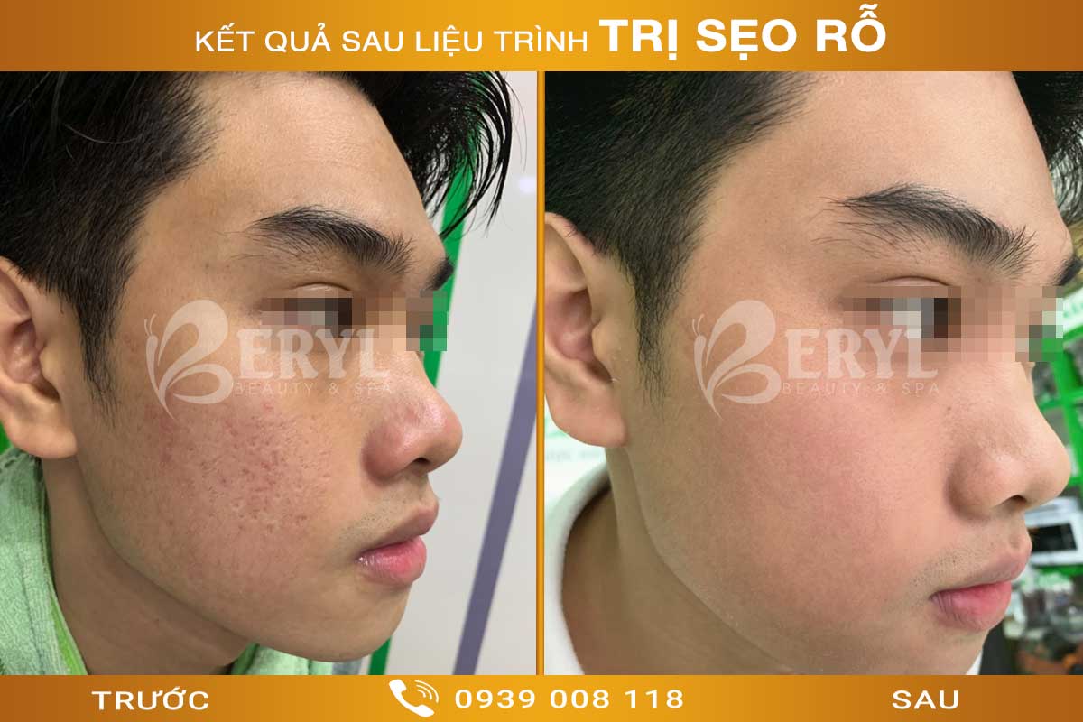Tham khảo hình ảnh trước và sau trị sẹo rỗ tại Beryl Beauty & Spa Tham khảo hình ảnh trước và sau trị sẹo rỗ tại Beryl Beauty & Spa