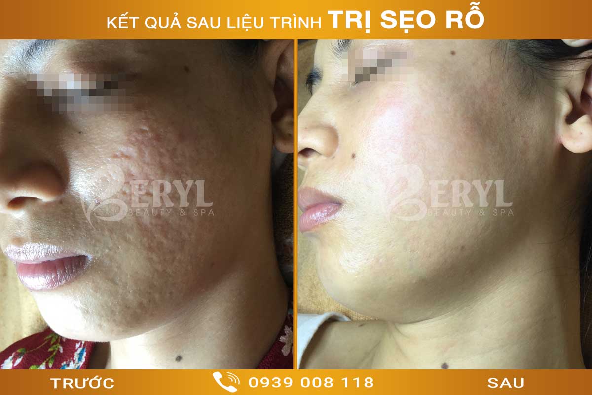 Tham khảo hình ảnh trước và sau trị sẹo rỗ tại Beryl Beauty & Spa Tham khảo hình ảnh trước và sau trị sẹo rỗ tại Beryl Beauty & Spa
