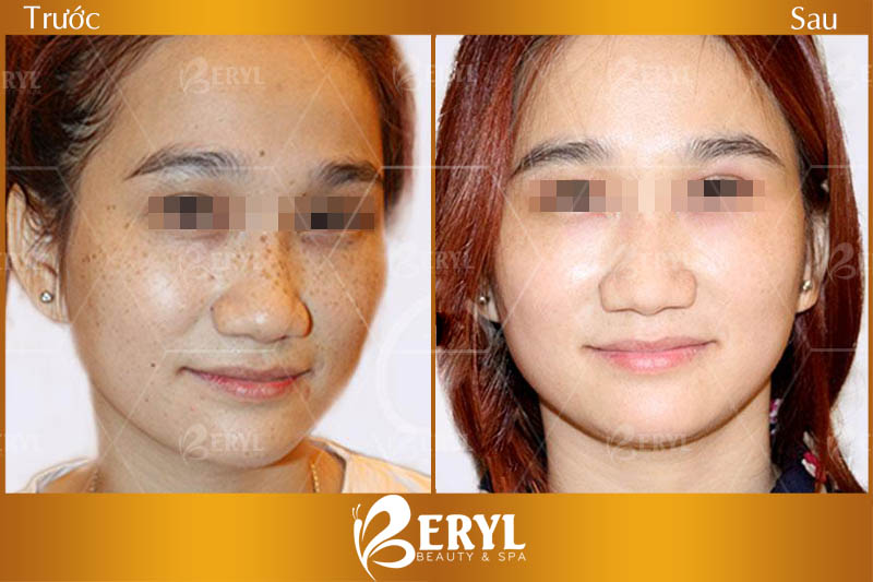 Hình ảnh trước và sau khi trị tàn nhang hiệu quả tại Beryl Beauty & Spa TPHCM Hình ảnh trước và sau khi trị tàn nhang hiệu quả tại Beryl Beauty & Spa TPHCM