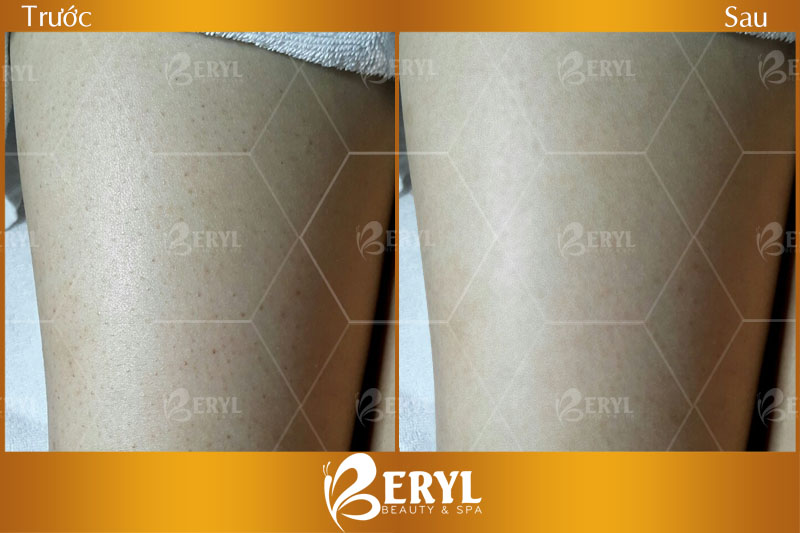 Hình ảnh trước sau điều trị viêm nang lông tại nhà bằng cao thuốc bắc. Hình ảnh trước sau điều trị viêm nang lông tại nhà bằng cao thuốc bắc.