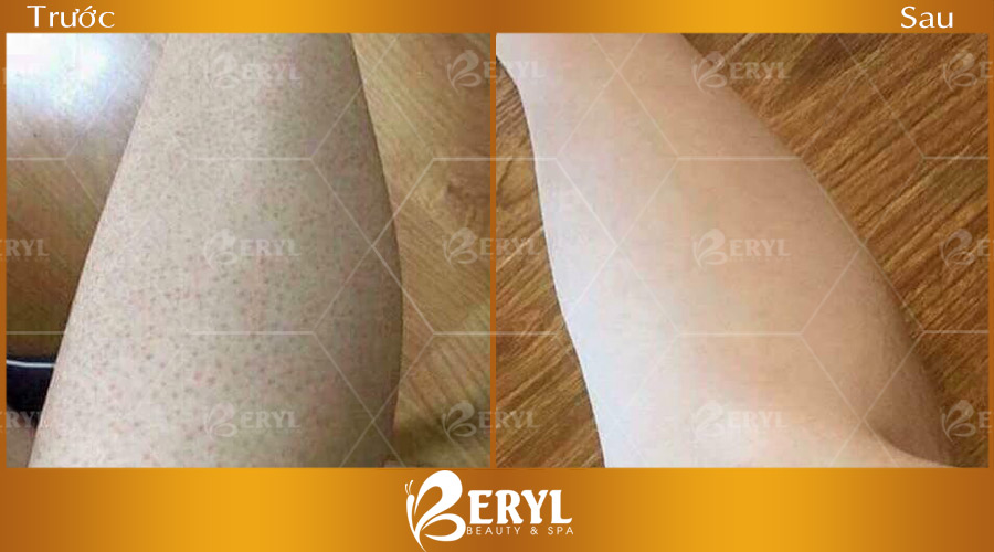 Hình trước và sau khi trị viêm nang lông tại nhà bằng Cao thuốc bắc. Hình trước và sau khi trị viêm nang lông tại nhà bằng Cao thuốc bắc.