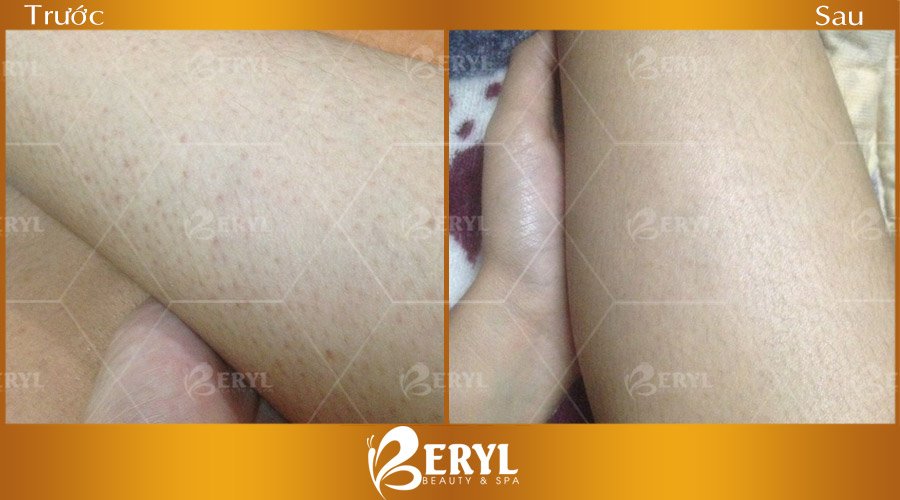 Hình trước và sau khi trị viêm nang lông tại nhà bằng Cao thuốc bắc. Hình trước và sau khi trị viêm nang lông tại nhà bằng Cao thuốc bắc.