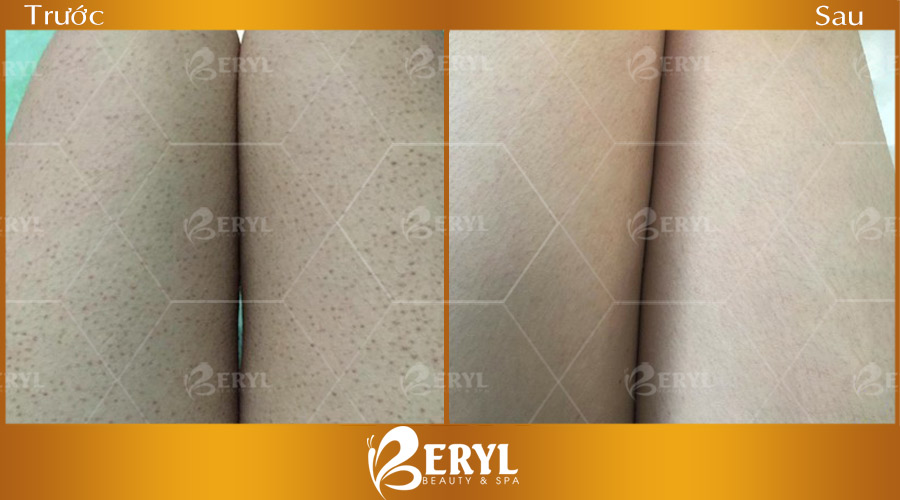 Hình trước và sau khi trị viêm nang lông tại nhà bằng Cao thuốc bắc. Hình trước và sau khi trị viêm nang lông tại nhà bằng Cao thuốc bắc.