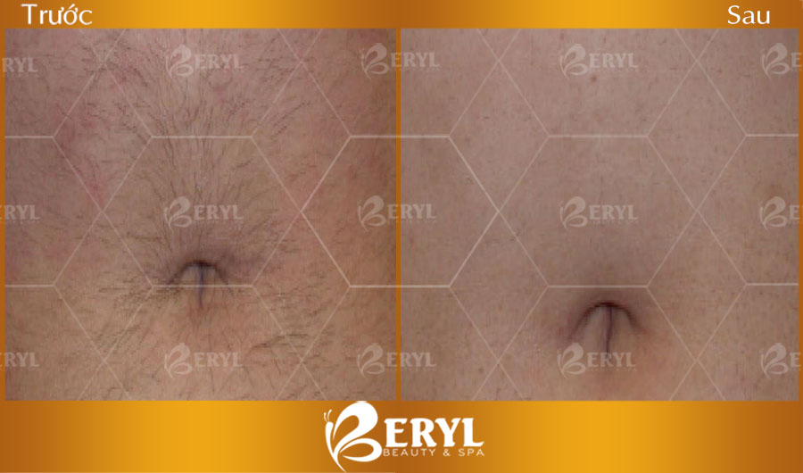 Hình ảnh trước và sau khi triệt lông cho nam giới tại Beryl Beauty & Spa Hình ảnh trước và sau khi triệt lông cho nam giới tại Beryl Beauty & Spa