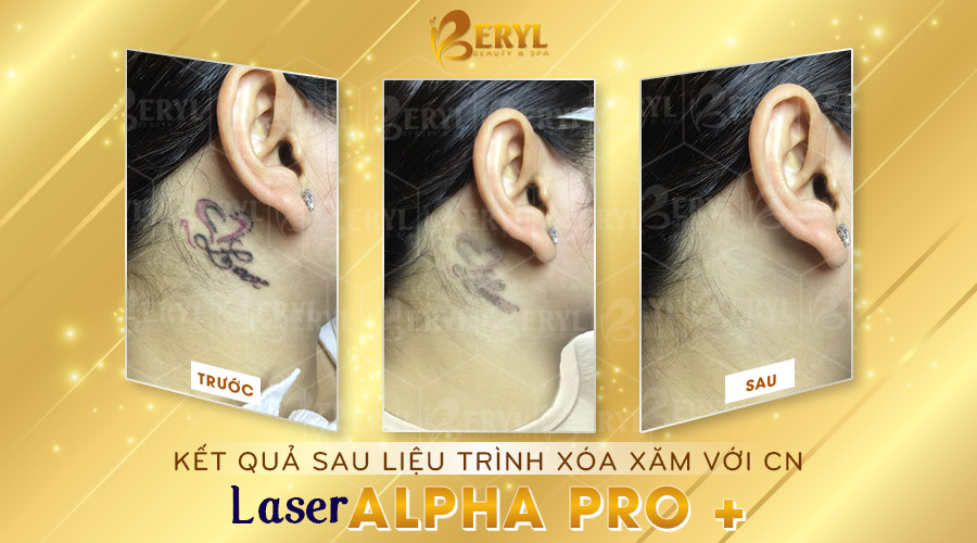 Hình ảnh trước và sau khi xóa hình xăm bằng Laser Alpha Pro+ tại Beryl Beauty. Hình ảnh trước và sau khi xóa hình xăm bằng Laser Alpha Pro+ tại Beryl Beauty.