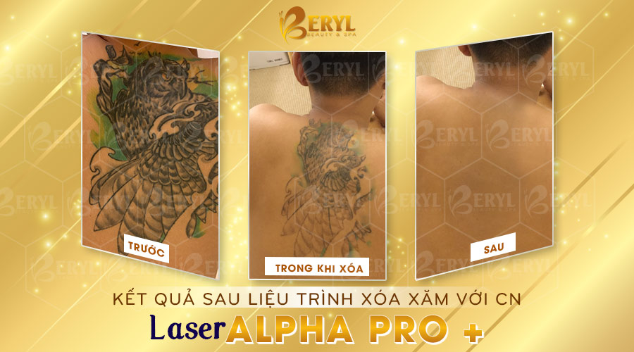 Hình ảnh trước và sau khi xóa hình xăm bằng Laser Alpha Pro+ tại Beryl Beauty. Hình ảnh trước và sau khi xóa hình xăm bằng Laser Alpha Pro+ tại Beryl Beauty.