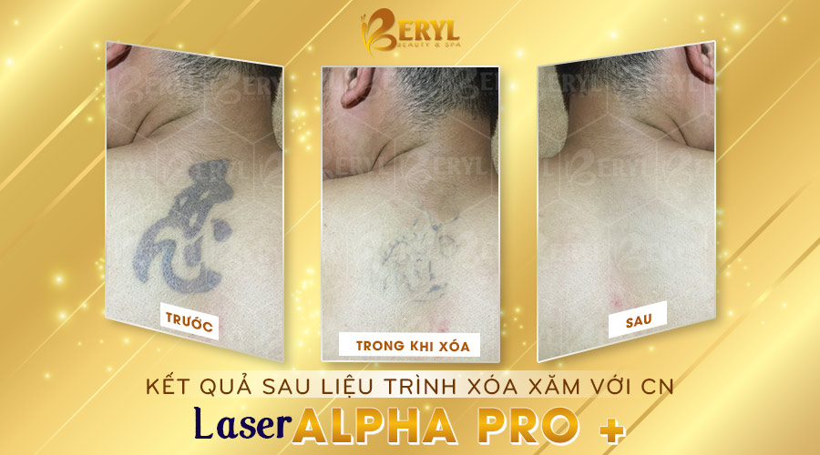 Hình ảnh trước và sau khi xóa hình xăm trên lưng bằng Laser Alpha Pro+ tại Beryl Beauty.  Hình ảnh trước và sau khi xóa hình xăm trên lưng bằng Laser Alpha Pro+ tại Beryl Beauty.