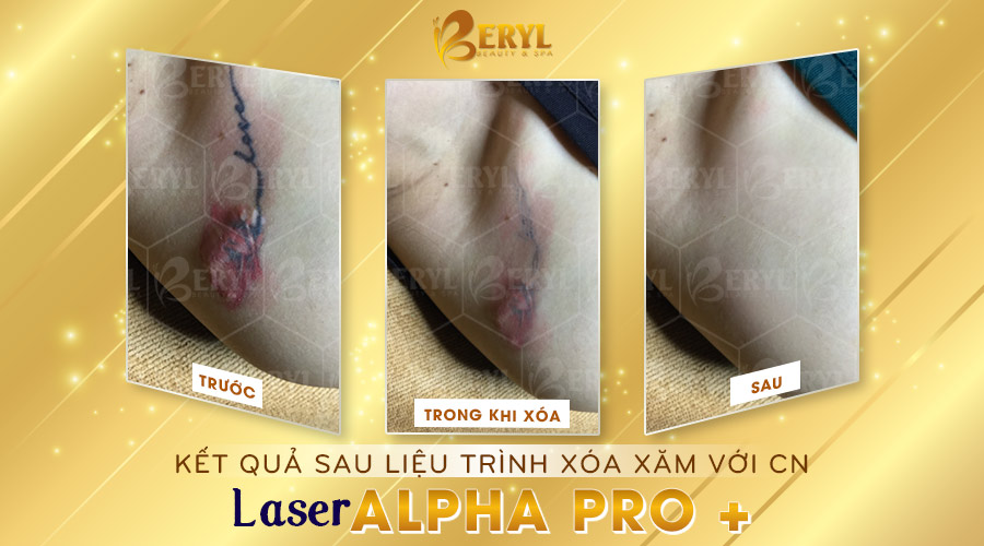 Hình ảnh trước và sau khi xóa hình xăm màu bằng Laser Alpha Pro+ tại Beryl Beauty. Hình ảnh trước và sau khi xóa hình xăm màu bằng Laser Alpha Pro+ tại Beryl Beauty.