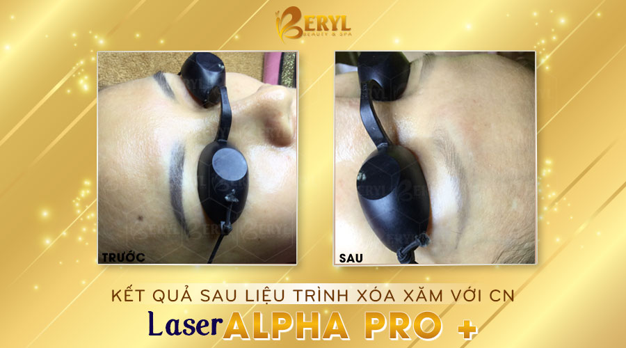 Hình ảnh trước và sau khi xóa xăm chân mày bằng Laser Alpha Pro+ tại Beryl Beauty. Hình ảnh trước và sau khi xóa xăm chân mày bằng Laser Alpha Pro+ tại Beryl Beauty.