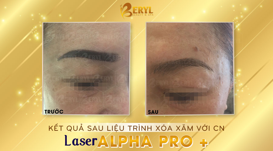 Hình ảnh trước và sau khi xóa xăm chân mày bằng Laser Alpha Pro+ tại Beryl Beauty. Hình ảnh trước và sau khi xóa xăm chân mày bằng Laser Alpha Pro+ tại Beryl Beauty.