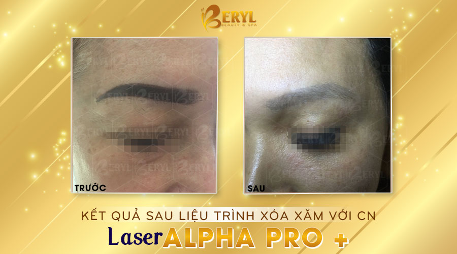 Hình ảnh trước và sau khi xóa xăm chân mày bằng Laser Alpha Pro+ tại Beryl Beauty. Hình ảnh trước và sau khi xóa xăm chân mày bằng Laser Alpha Pro+ tại Beryl Beauty.