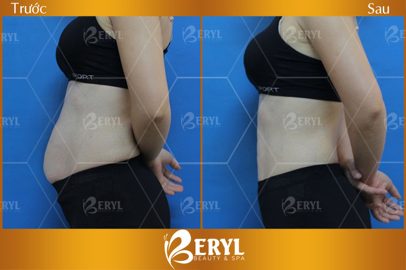 Hình ảnh trước và sau khi giảm béo tại Beryl Beauty & Spa Hình ảnh trước và sau khi giảm béo tại Beryl Beauty & Spa