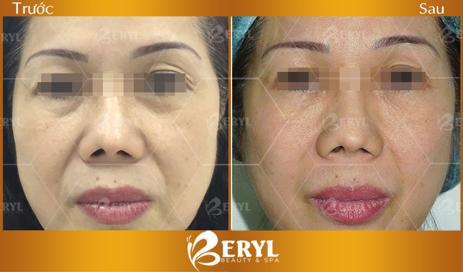 Hình ảnh trước và sau khi nâng cơ mặt bằng công nghệ Utherapy và Duel Thermage tại Beryl Beauty Hình ảnh trước và sau khi nâng cơ mặt bằng công nghệ Utherapy và Duel Thermage tại Beryl Beauty
