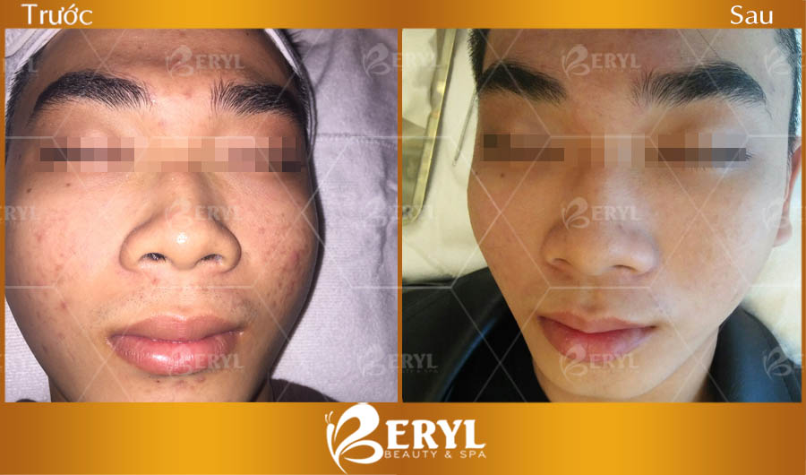 Hình ảnh trước và sau khi điều trị mụn cho nam giới tại Beryl Beauty & Spa TPHCM Hình ảnh trước và sau khi điều trị mụn cho nam giới tại Beryl Beauty & Spa TPHCM