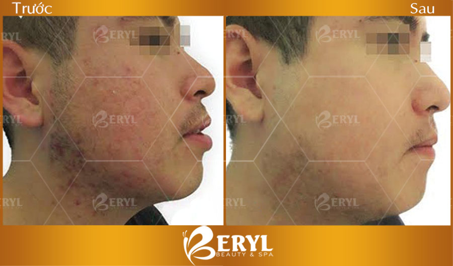 Hình ảnh trước và sau khi điều trị mụn cho nam giới tại Beryl Beauty & Spa TPHCM Hình ảnh trước và sau khi điều trị mụn cho nam giới tại Beryl Beauty & Spa TPHCM