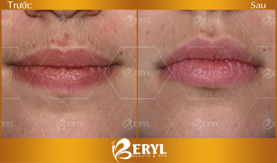 Hình ảnh trước và sau khi triệt lông cho nam giới tại Beryl Beauty & Spa Hình ảnh trước và sau khi triệt lông cho nam giới tại Beryl Beauty & Spa