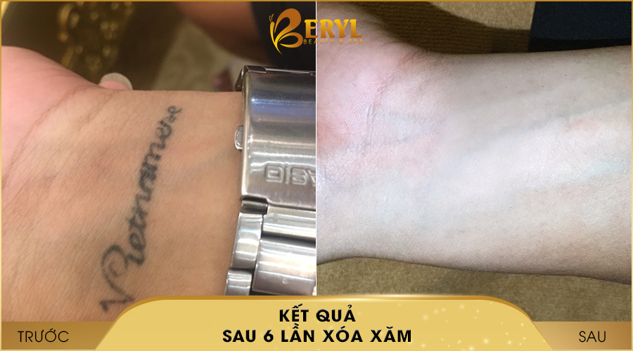 Hình ảnh trước và sau khi xóa hình xăm bằng Laser Toning tại Beryl Beauty & Spa Hình ảnh trước và sau khi xóa hình xăm bằng Laser Toning tại Beryl Beauty & Spa