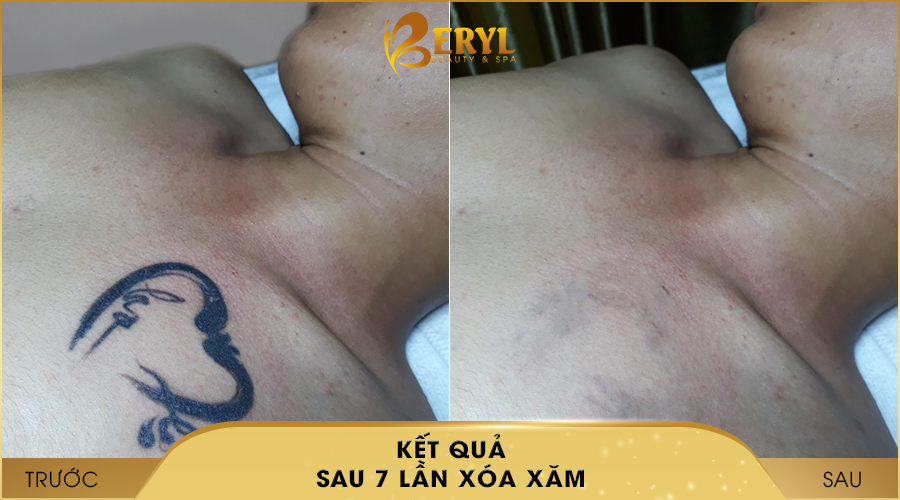 Hình ảnh trước và sau khi xóa hình xăm bằng Laser Toning tại Beryl Beauty & Spa Hình ảnh trước và sau khi xóa hình xăm bằng Laser Toning tại Beryl Beauty & Spa