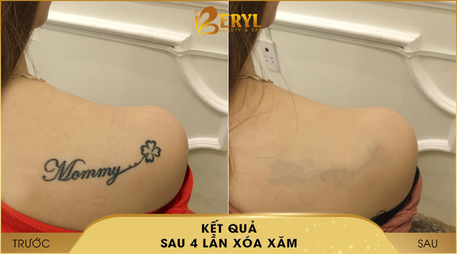 Hình ảnh trước và sau khi xóa hình xăm bằng CN đỉnh cao AlphaTech Pro tại Beryl Beauty & Spa Hình ảnh trước và sau khi xóa hình xăm bằng CN đỉnh cao AlphaTech Pro tại Beryl Beauty & Spa