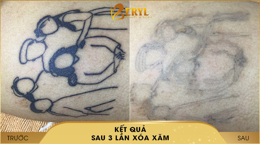Hình ảnh trước và sau khi xóa hình xăm bằng Laser Toning tại Beryl Beauty & Spa Hình ảnh trước và sau khi xóa hình xăm bằng Laser Toning tại Beryl Beauty & Spa