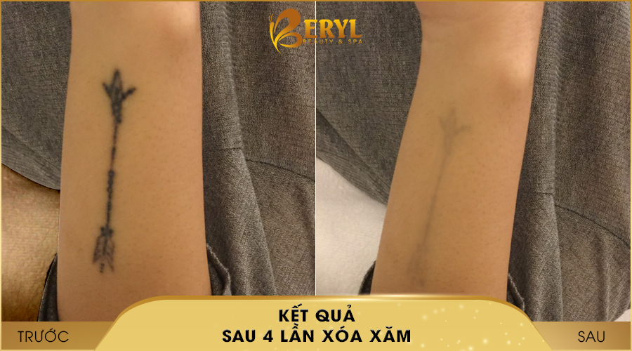 Hình ảnh trước và sau khi xóa hình xăm bằng Laser Toning tại Beryl Beauty & Spa Hình ảnh trước và sau khi xóa hình xăm bằng Laser Toning tại Beryl Beauty & Spa