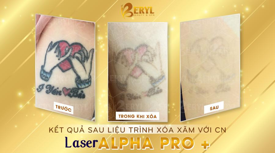 Hình ảnh trước và sau khi xóa hình xăm màu bằng Laser Alpha Pro+ tại Beryl Beauty.  Hình ảnh trước và sau khi xóa hình xăm màu bằng Laser Alpha Pro+ tại Beryl Beauty.