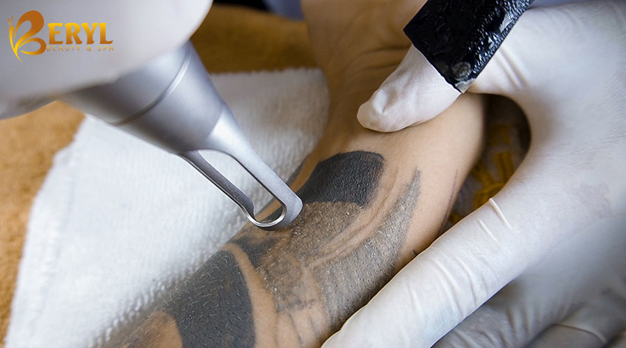 Xóa hình xăm bằng laser Xóa hình xăm bằng laser