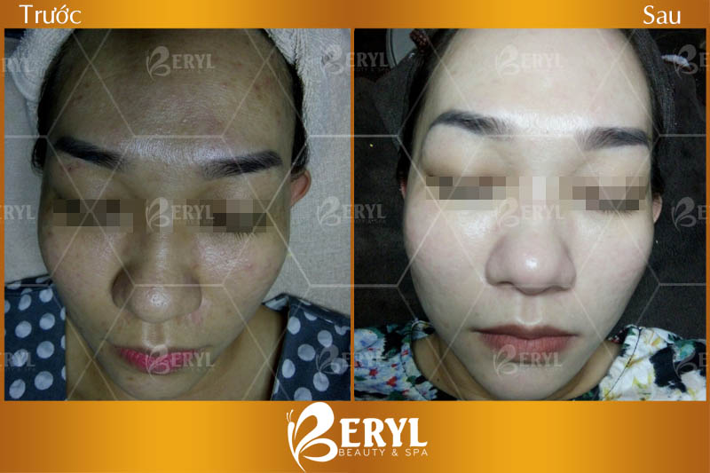 Hình ảnh trước và sau làm trắng da mặt bằng công nghệ Baby Skin tại Beryl Beauty Hình ảnh trước và sau làm trắng da mặt bằng công nghệ Baby Skin tại Beryl Beauty