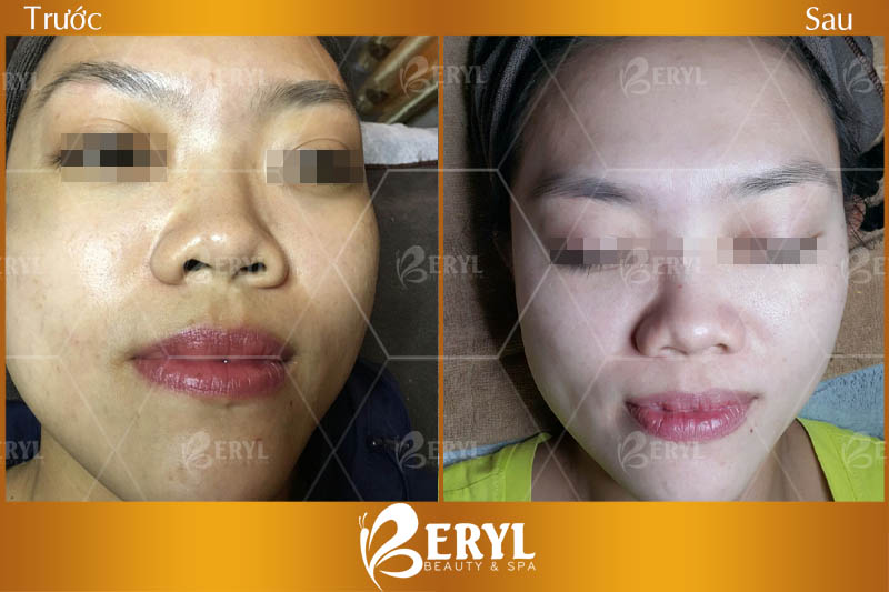 Hình ảnh trước và sau làm trắng da mặt bằng công nghệ Baby Skin tại Beryl Beauty Hình ảnh trước và sau làm trắng da mặt bằng công nghệ Baby Skin tại Beryl Beauty