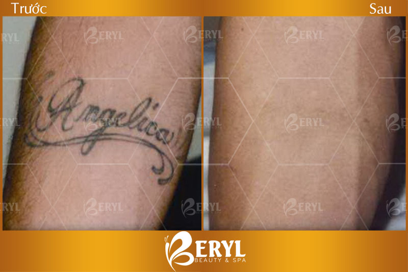 Hình ảnh trước và sau khi xoá xăm tại Beryl Beauty Hình ảnh trước và sau khi xoá xăm tại Beryl Beauty