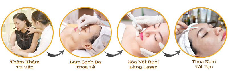 Quy trình xóa nốt ruồi bằng công nghệ Laser Tại Beryl Beauty & Spa Quy trình xóa nốt ruồi bằng công nghệ Laser Tại Beryl Beauty & Spa
