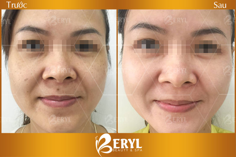 Hình ảnh trước và sau khi điều trị tàn nhang bằng công nghệ Laser Yag tại Beryl Beauty & Spa Hình ảnh trước và sau khi điều trị tàn nhang bằng công nghệ Laser Yag tại Beryl Beauty & Spa