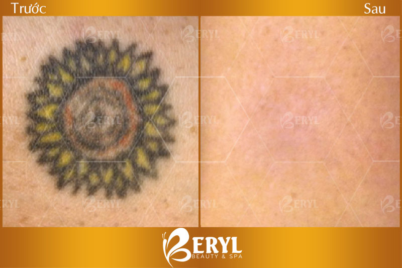 Hình ảnh xoá xăm bằng công nghệ Laser Toning Hình ảnh xoá xăm bằng công nghệ Laser Toning