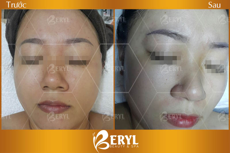 Hình ảnh trước và sau làm trắng da mặt bằng công nghệ Baby Skin tại Beryl Beauty Hình ảnh trước và sau làm trắng da mặt bằng công nghệ Baby Skin tại Beryl Beauty