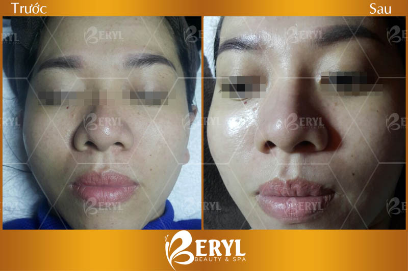 Hình ảnh trước và sau làm trắng da mặt bằng công nghệ Baby Skin tại Beryl Beauty Hình ảnh trước và sau làm trắng da mặt bằng công nghệ Baby Skin tại Beryl Beauty