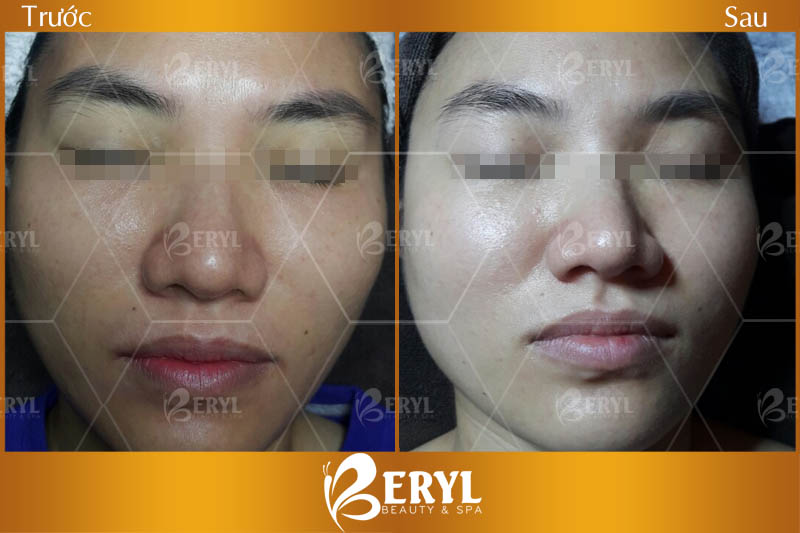 Hình ảnh trước và sau làm trắng da mặt bằng công nghệ Baby Skin tại Beryl Beauty Hình ảnh trước và sau làm trắng da mặt bằng công nghệ Baby Skin tại Beryl Beauty