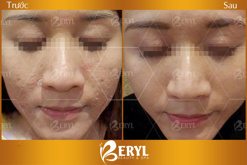 HÌnh ảnh trước và sau khi điều trị sẹo rỗ bằng công nghệ phi kim vi điểm với tế bào gốc tại Beryl Beauty & Spa HÌnh ảnh trước và sau khi điều trị sẹo rỗ bằng công nghệ phi kim vi điểm với tế bào gốc tại Beryl Beauty & Spa