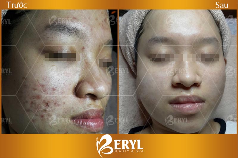 Hình ảnh trước và sau khi điều trị thâm mụn bằng công nghệ Magic Skin tại Beryl Beauty Hình ảnh trước và sau khi điều trị thâm mụn bằng công nghệ Magic Skin tại Beryl Beauty