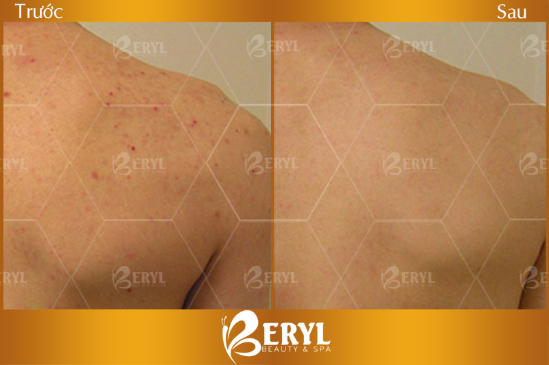 Hình ảnh trước và sau khi điều trị mụn ở lưng bằng công nghệ Blue Light tại Beryl Beauty & Spa Hình ảnh trước và sau khi điều trị mụn ở lưng bằng công nghệ Blue Light tại Beryl Beauty & Spa