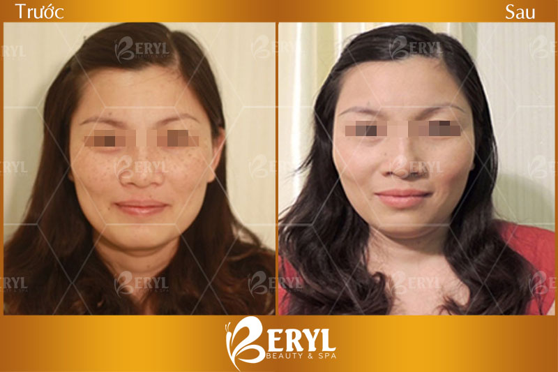 Hình ảnh trước và sau khi điều trị tàn nhang bằng công nghệ Laser Yag tại Beryl Beauty & Spa Hình ảnh trước và sau khi điều trị tàn nhang bằng công nghệ Laser Yag tại Beryl Beauty & Spa