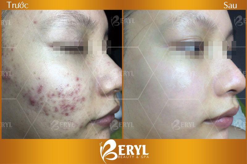 Hình ảnh trước và sau khi điều trị thâm mụn bằng công nghệ Magic Skin tại Beryl Beauty Hình ảnh trước và sau khi điều trị thâm mụn bằng công nghệ Magic Skin tại Beryl Beauty