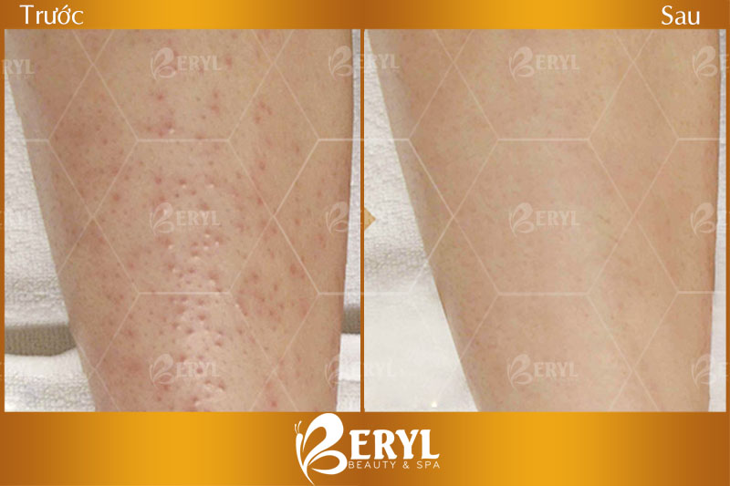 Hình ảnh trước và sau khi điều trị viêm nang lông-bằng ánh sáng sinh học tại Beryl Beauty Hình ảnh trước và sau khi điều trị viêm nang lông-bằng ánh sáng sinh học tại Beryl Beauty
