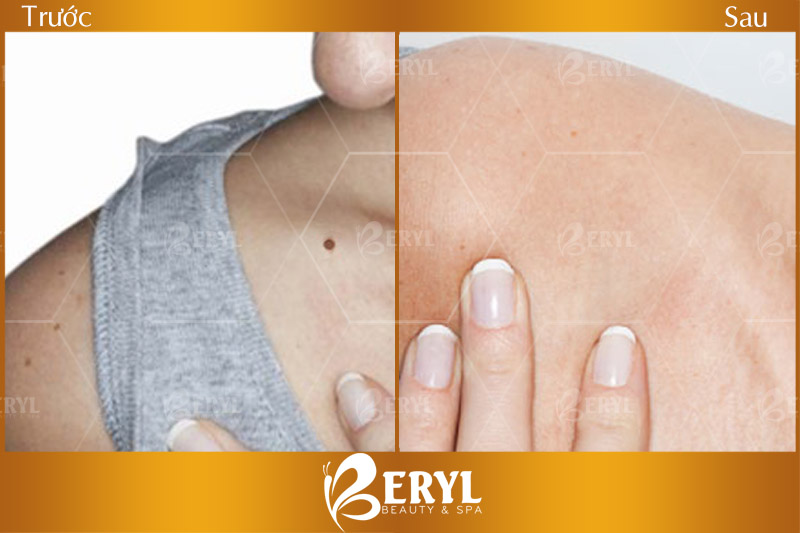 Hình ảnh trước và sau xóa nốt ruồi bằng Laser tại Beryl Beauty & Spa Hình ảnh trước và sau xóa nốt ruồi bằng Laser tại Beryl Beauty & Spa