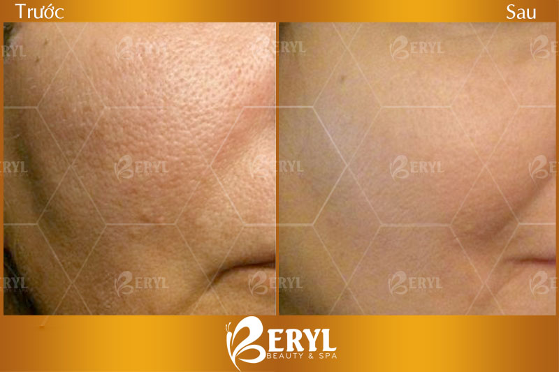 HÌnh ảnh trước và sau khi điều trị sẹo rỗ bằng công nghệ phi kim vi điểm với tế bào gốc tại Beryl Beauty & Spa HÌnh ảnh trước và sau khi điều trị sẹo rỗ bằng công nghệ phi kim vi điểm với tế bào gốc tại Beryl Beauty & Spa