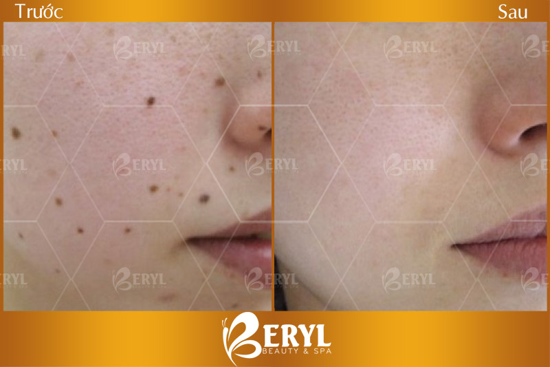 Hình ảnh trước và sau xóa nốt ruồi bằng Laser tại Beryl Beauty & Spa Hình ảnh trước và sau xóa nốt ruồi bằng Laser tại Beryl Beauty & Spa