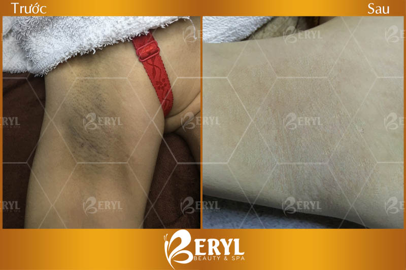 Điều trị thâm nách bằng công nghệ Peeling tại Beryl Beauty & Spa Điều trị thâm nách bằng công nghệ Peeling tại Beryl Beauty & Spa
