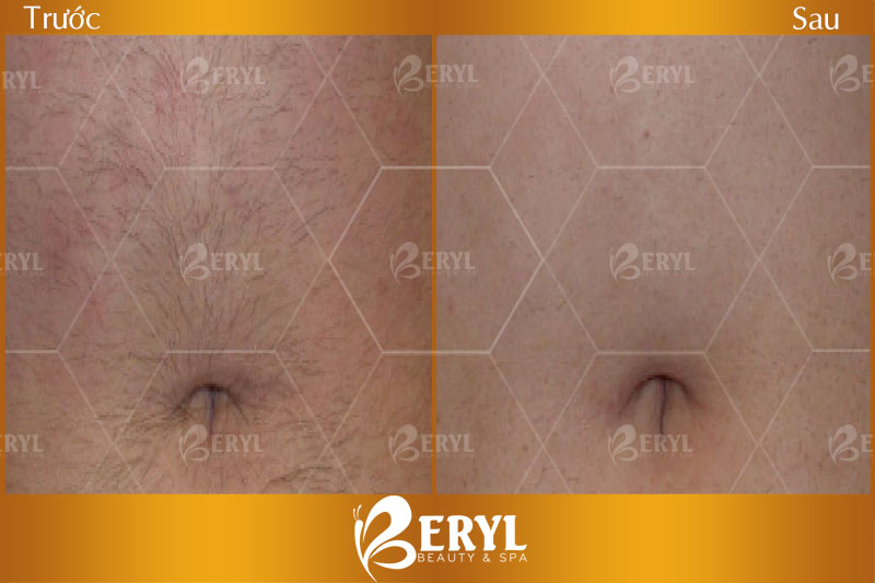 Hình ảnh trước và sau khi triệt lông bằng công nghệ SHR AFT IPL tại Beryl Beauty Hình ảnh trước và sau khi triệt lông bằng công nghệ SHR AFT IPL tại Beryl Beauty