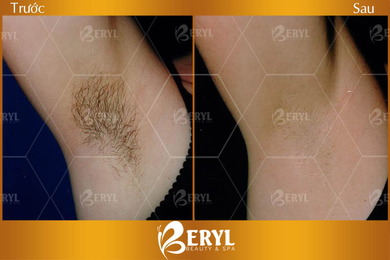 Hình ảnh trước và sau khi triệt lông bằng công nghệ SHR AFT IPL tại Beryl Beauty Hình ảnh trước và sau khi triệt lông bằng công nghệ SHR AFT IPL tại Beryl Beauty