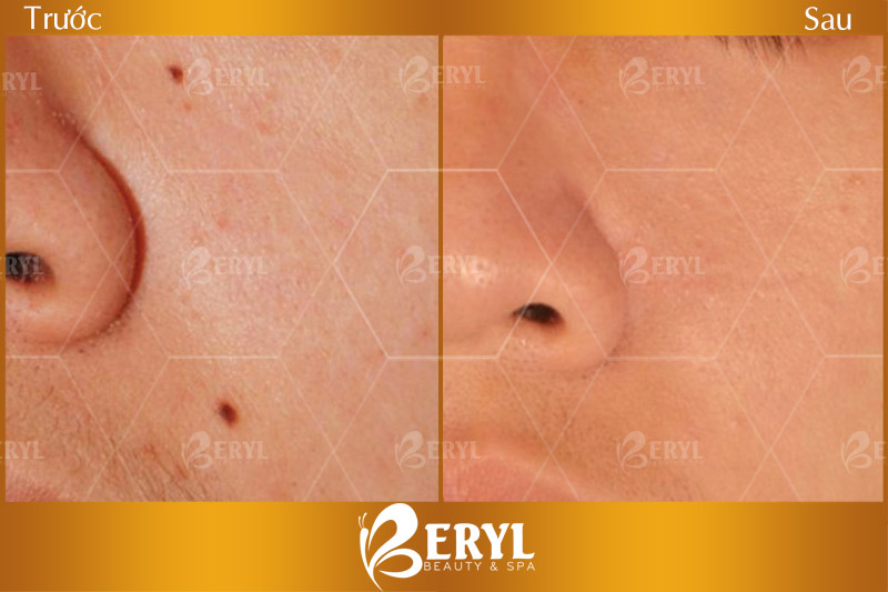 Hình ảnh trước và sau xóa nốt ruồi bằng Laser tại Beryl Beauty & Spa Hình ảnh trước và sau xóa nốt ruồi bằng Laser tại Beryl Beauty & Spa